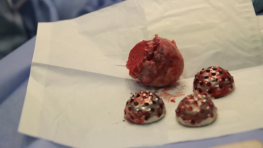 Header of Acetabular