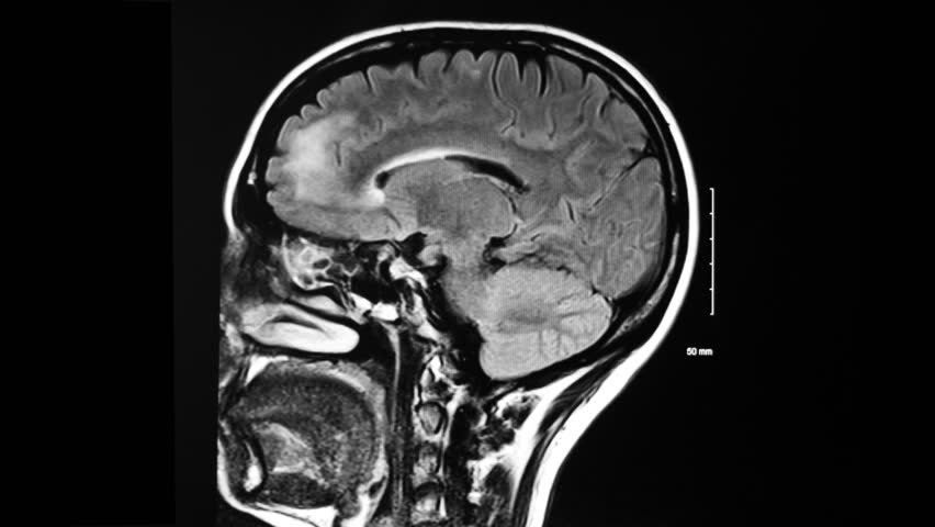 multiple-sclerosis-definition-meaning