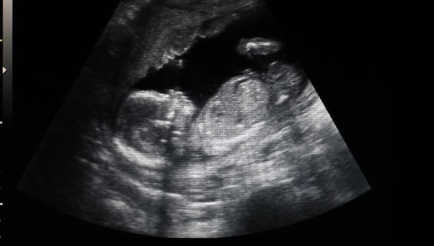 Ultrasound Stock Footage Video - Shutterstock